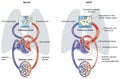 Acute cardiogenic pulmonary oedema