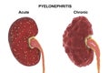 Acute and chronic pyelonephritis, medical concept