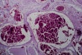 Acute glomerulonephritis, light micrograph