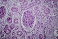 Acute glomerulonephritis, light micrograph