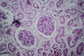 Acute glomerulonephritis, light micrograph