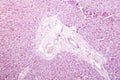 Acute hepatic congestion, light micrograph Royalty Free Stock Photo