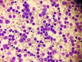 Acute leukemia in a blood smear. Hematology. Royalty Free Stock Photo