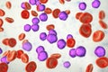 Acute lymphoblastic leukemia