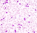 Acute lymphoblastic leukemia(ALL)