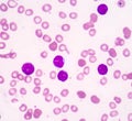 Acute lymphoblastic leukemia(ALL) Royalty Free Stock Photo