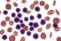 Acute lymphoblastic leukemia, bone marrow smear