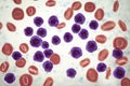 Acute lymphoblastic leukemia, bone marrow smear