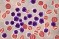 Acute lymphoblastic leukemia, bone marrow smear