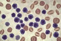 Acute lymphoblastic leukemia, bone marrow smear