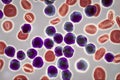 Acute lymphoblastic leukemia, bone marrow smear