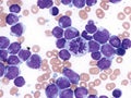 Acute lymphoid leukemia in bone marrow. Royalty Free Stock Photo