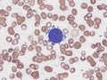 Acute megakaryoblastic leukemia.