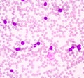 Acute myeloblastic leukemia(AML)