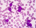 Acute myeloblastic leukemia(AML)