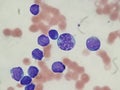 Acute myelocytic leukemia seen on peripheral blood smear Royalty Free Stock Photo