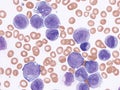 Acute myeloid leukemia.