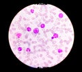 Microscopic examination of blasts or leukemia cells in blood smear of human.