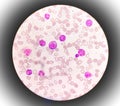 Microscopic examination of blasts or leukemia cells in blood smear of human.