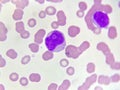 Acute myeloid leukemia