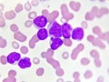 Acute myeloid leukemia