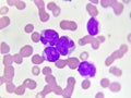 Acute myeloid leukemia