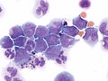 Acute myeloid leukemia with meningeal involvement.