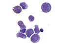 Acute myeloid leukemia in pleural fluid. Royalty Free Stock Photo