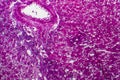 Acute nephritis, light micrograph Royalty Free Stock Photo