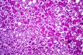 Acute nephritis, light micrograph Royalty Free Stock Photo