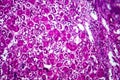 Acute nephritis, light micrograph Royalty Free Stock Photo