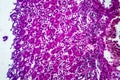 Acute nephritis, light micrograph Royalty Free Stock Photo