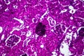 Acute nephritis, light micrograph Royalty Free Stock Photo
