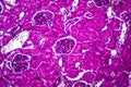 Acute nephritis, light micrograph Royalty Free Stock Photo
