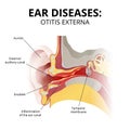 acute otitis externa, sectional image on white background