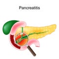 Acute pancreatitis. Close-up of a realistic pancreas, duodenum, and gallbladder