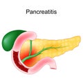 Acute pancreatitis. Duodenum, gallbladder and pancreas Royalty Free Stock Photo