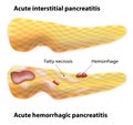 Acute Pancreatitis Royalty Free Stock Photo