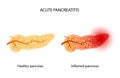 Pancreas disease and cancer