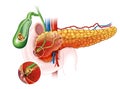 Acute pancreatitis, medically illustration Royalty Free Stock Photo