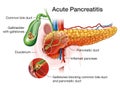 Acute pancreatitis, medically illustration Royalty Free Stock Photo