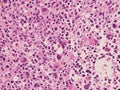 Acute panmyelosis with myelofibrosis. Royalty Free Stock Photo