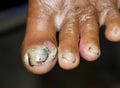 Acute paronychia and tinea pedis at big toe of Southeast Asian elderly woman.