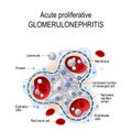 Acute proliferative glomerulonephritis Royalty Free Stock Photo