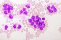 Acute promyelocytic leukemia cells or APL