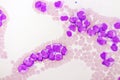 Acute promyelocytic leukemia cells or APL Royalty Free Stock Photo