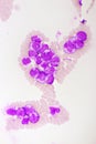 Acute promyelocytic leukemia cells or APL Royalty Free Stock Photo