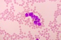 Acute promyelocytic leukemia cells or APL Royalty Free Stock Photo