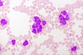 Acute promyelocytic leukemia cells or APL Royalty Free Stock Photo