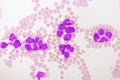 Acute promyelocytic leukemia cells or APL Royalty Free Stock Photo